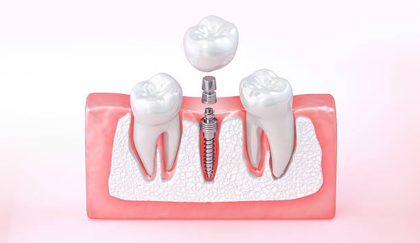 Dental Implants Melbourne: Advanced Smile Solutions with My Implant Dentist Melbourne